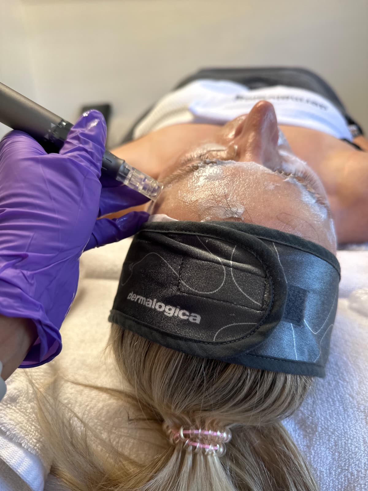 MICRONEEDLING WITH EXOSOMAS