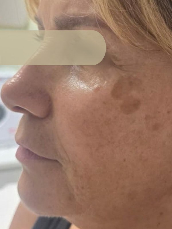 Before Melasma / Dark Spots treatment at NP Skin Care