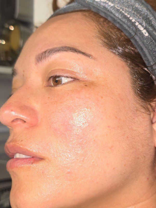 After Melasma / Dark Spots treatment at NP Skin Care