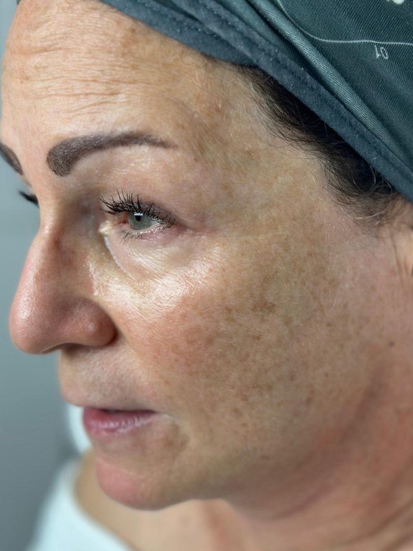 Before Microchanneling at NP Skin Care