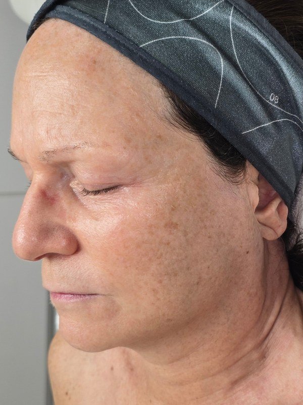 After Microchanneling at NP Skin Care
