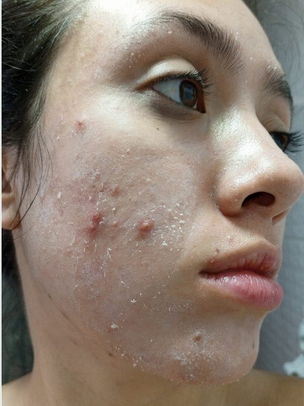 Before Acne Treatment at NP Skin Care