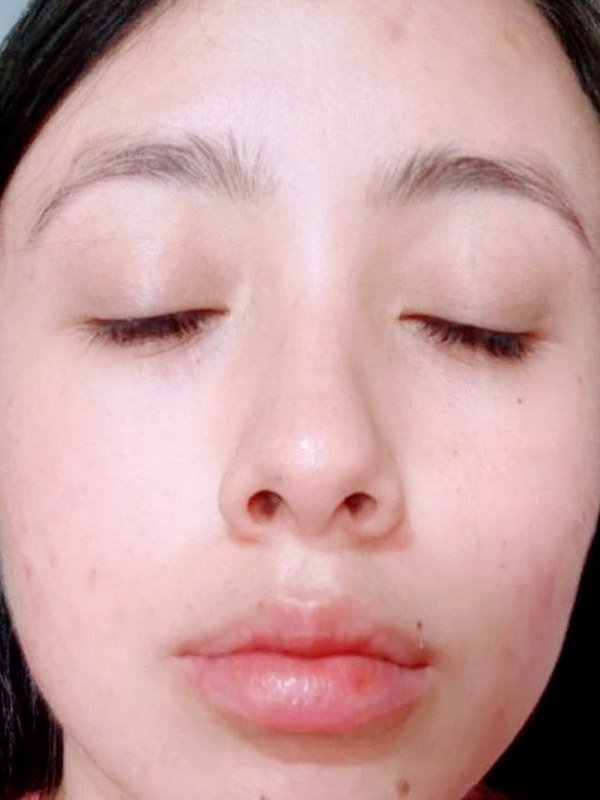 After Acne Treatment at NP Skin Care