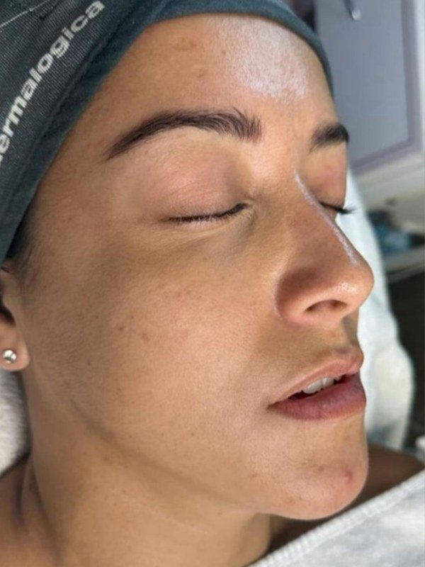 Before Texture & Pores treatment at NP Skin Care