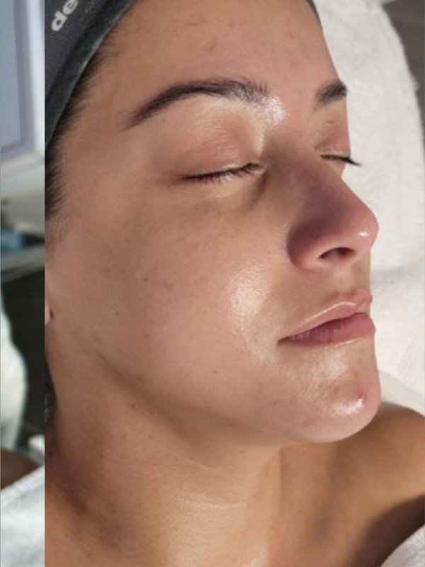 After Texture & Pores treatment at NP Skin Care