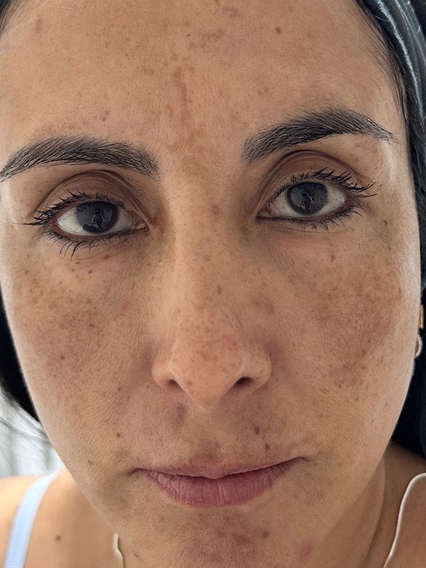 Before Chemical Peel at NP Skin Care