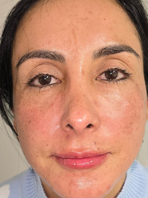 After Chemical Peel at NP Skin Care