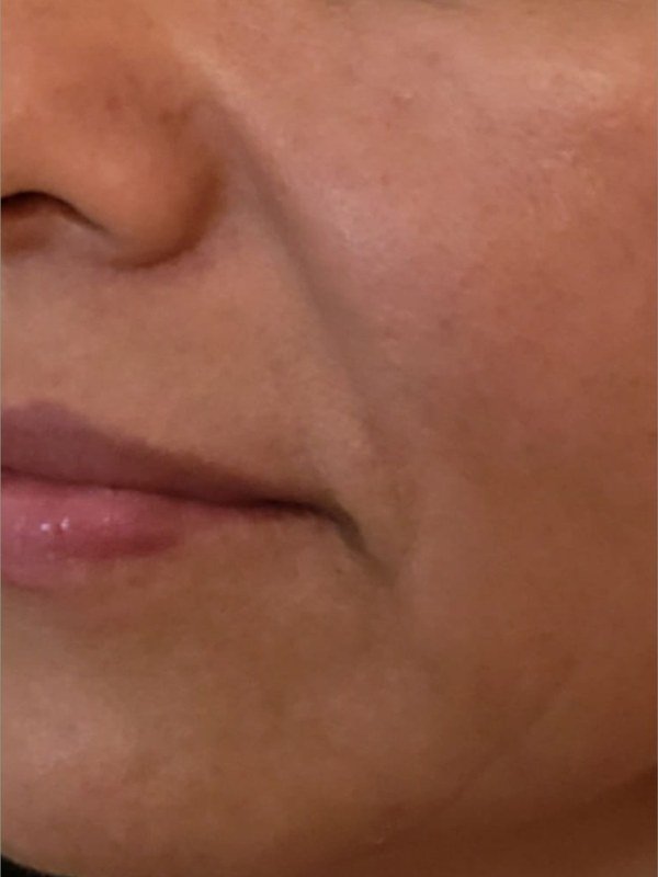 Before Melasma / Dark Spots treatment at NP Skin Care