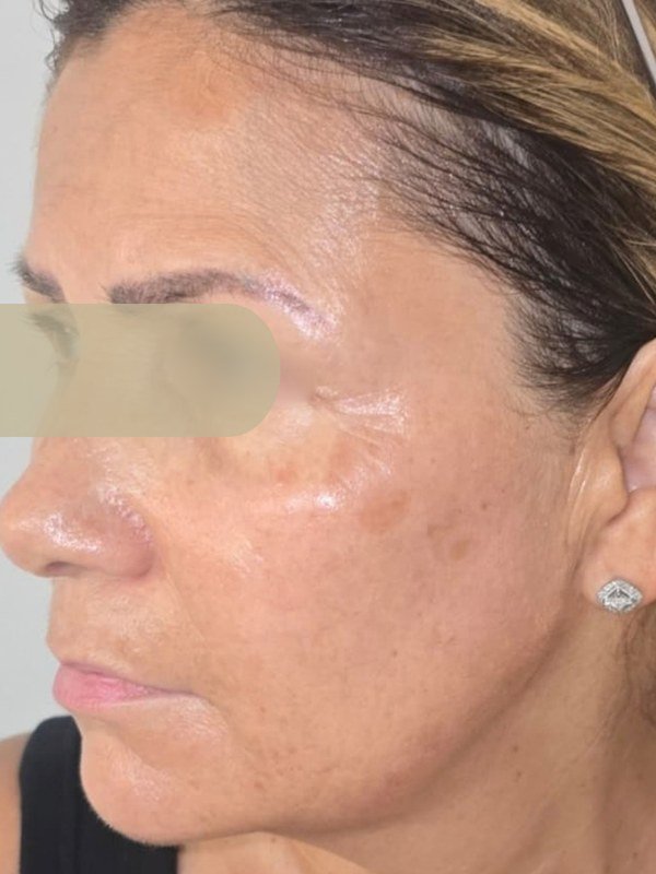 After Melasma / Dark Spots treatment at NP Skin Care
