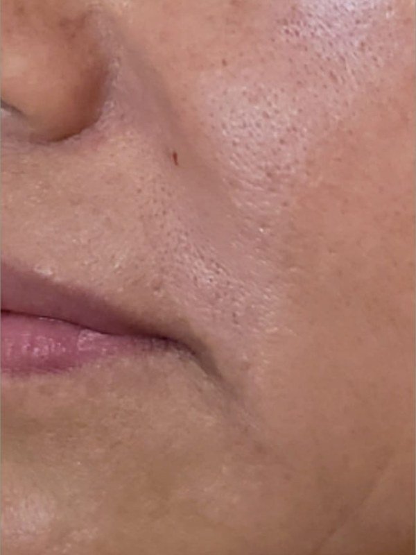 After Melasma / Dark Spots treatment at NP Skin Care