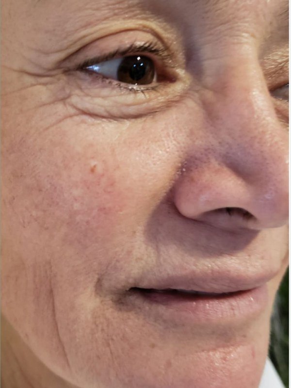 Before Anti-Aging treatment at NP Skin Care