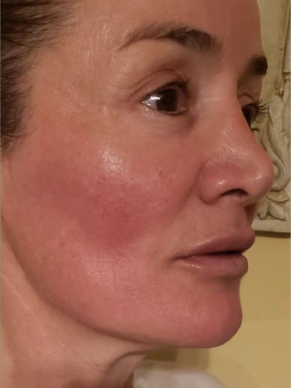 After Anti-Aging treatment at NP Skin Care