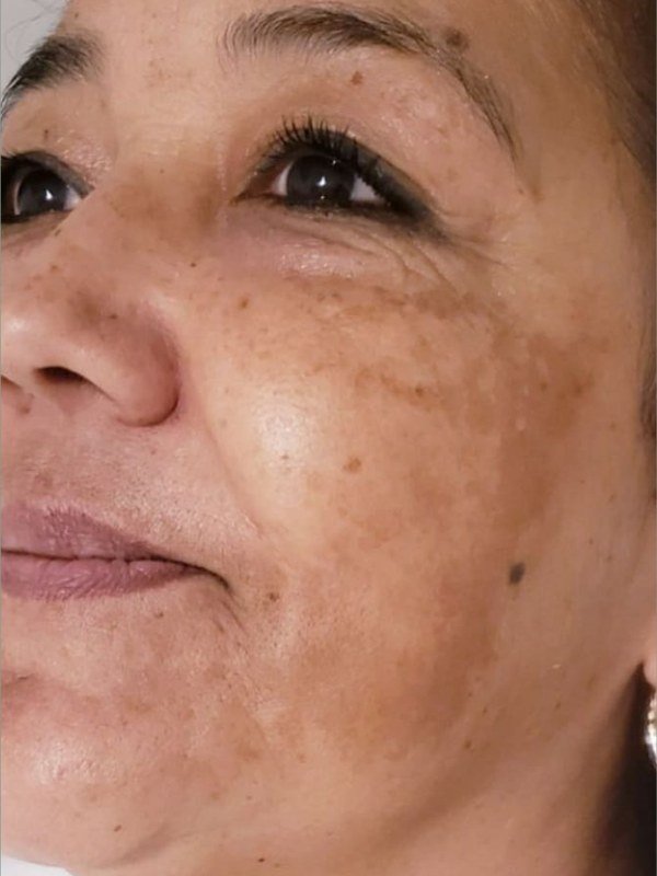 Before Melasma / Dark Spots treatment at NP Skin Care