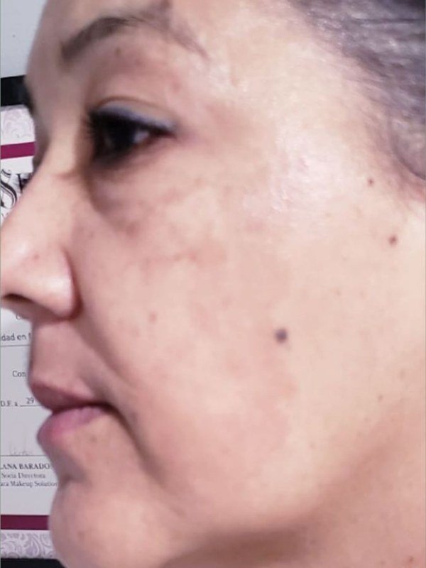 After Melasma / Dark Spots treatment at NP Skin Care