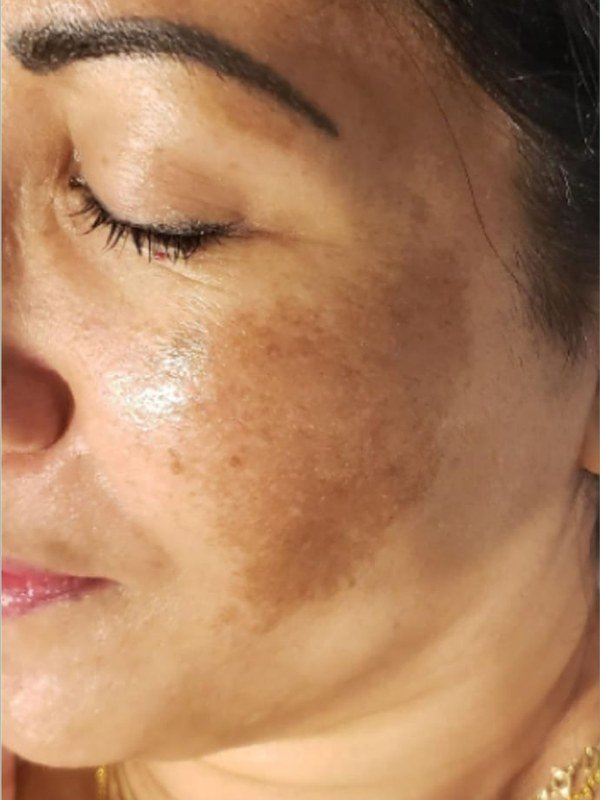 Before Melasma / Dark Spots treatment at NP Skin Care
