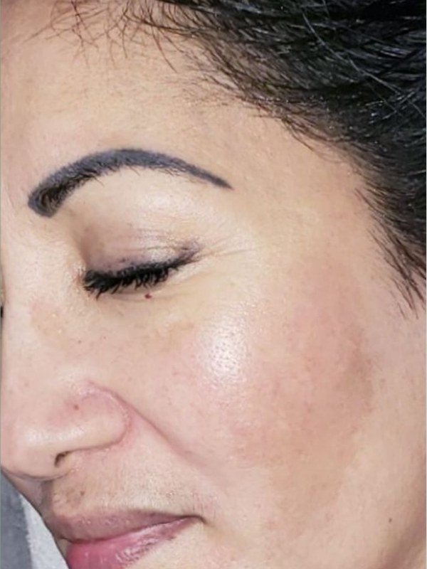 After Melasma / Dark Spots treatment at NP Skin Care