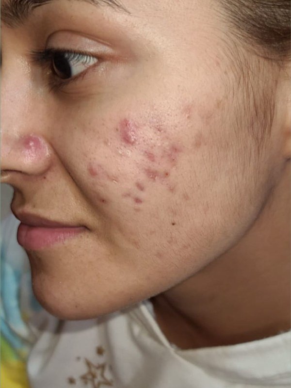Before Acne treatment at NP Skin Care