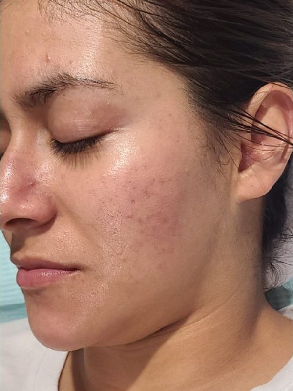After Acne treatment at NP Skin Care