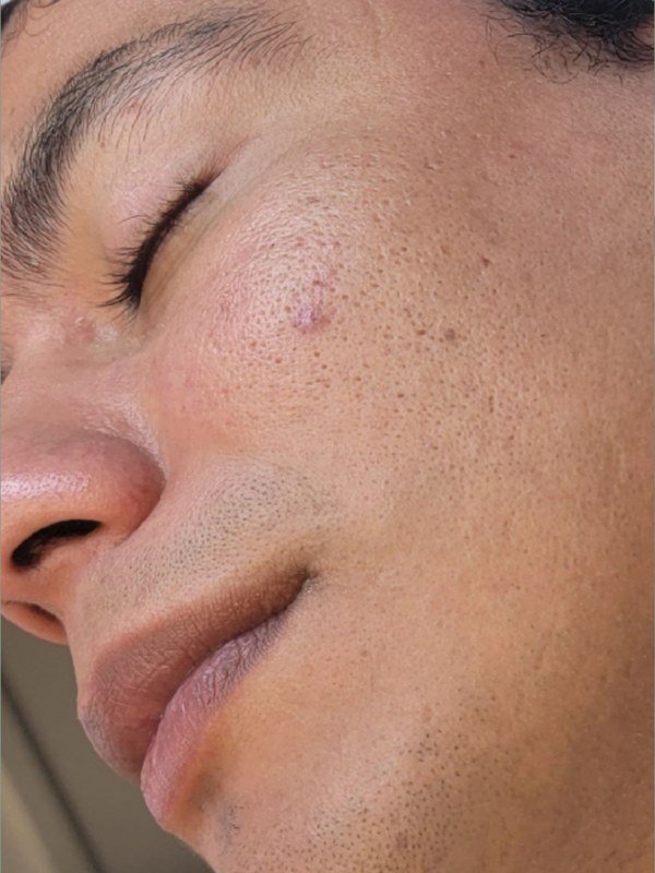 Before Acne treatment at NP Skin Care