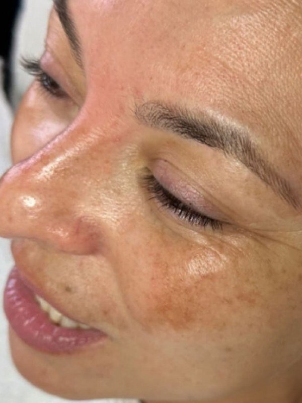 Before Melasma / Dark Spots treatment at NP Skin Care
