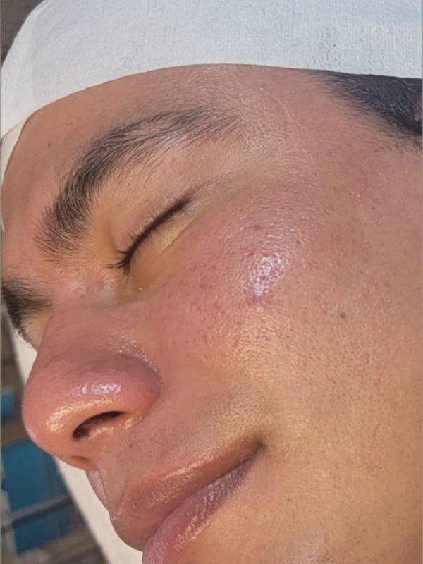 After Acne treatment at NP Skin Care