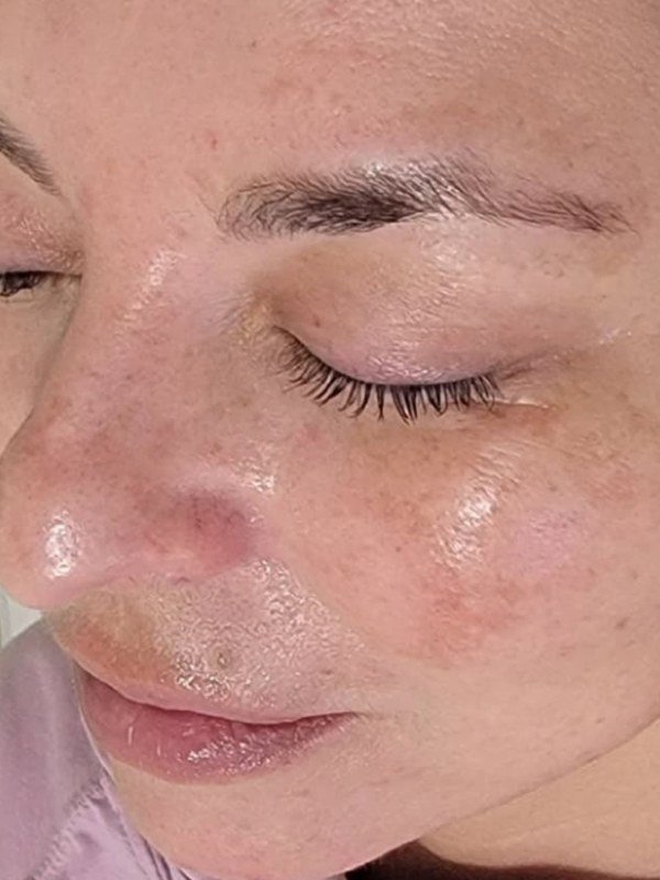 After Melasma / Dark Spots treatment at NP Skin Care