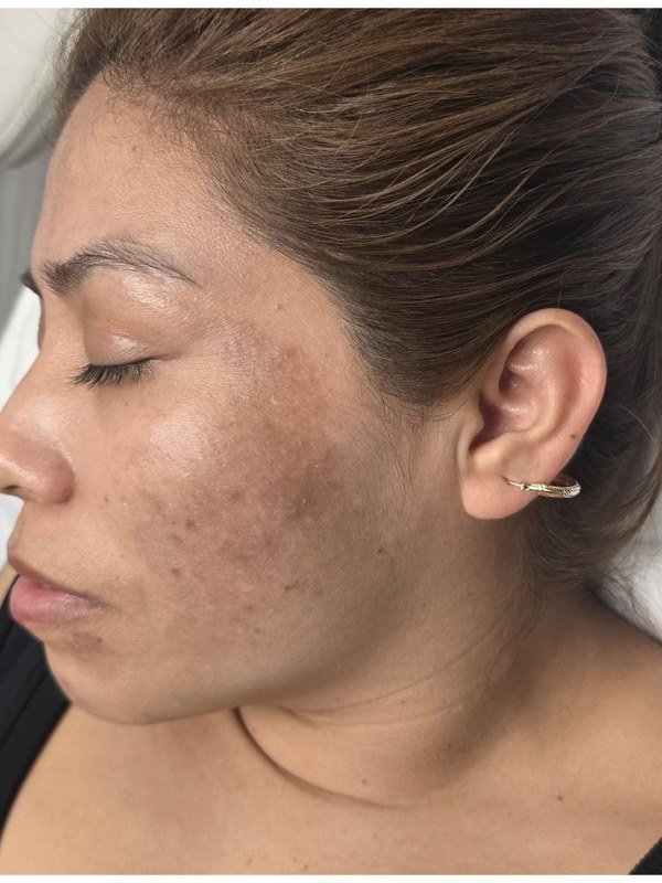 Before Melasma / Dark Spots treatment at NP Skin Care