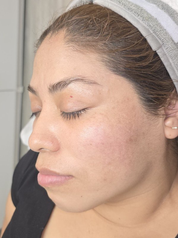 After Melasma / Dark Spots treatment at NP Skin Care