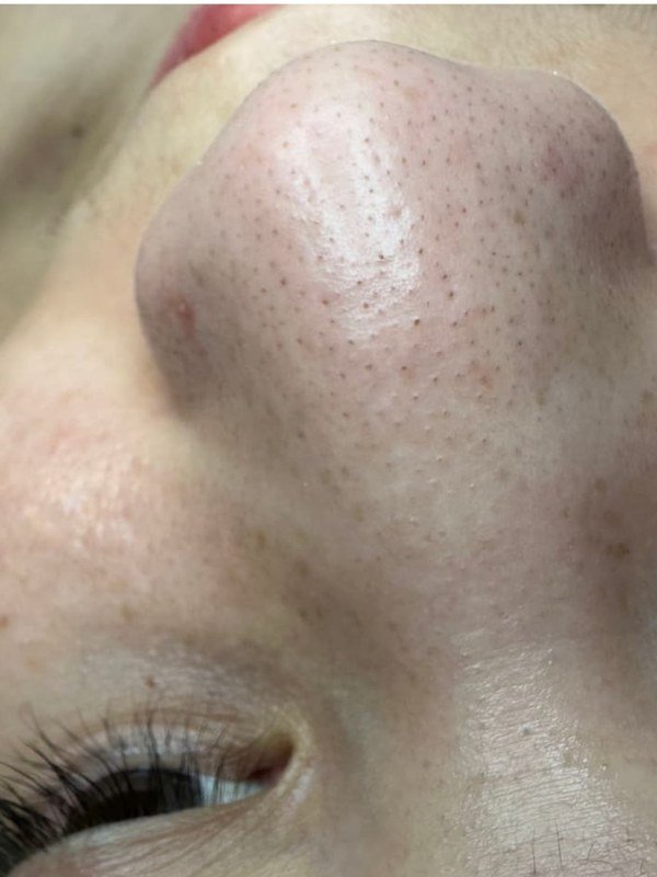 Before Microneedling at NP Skin Care