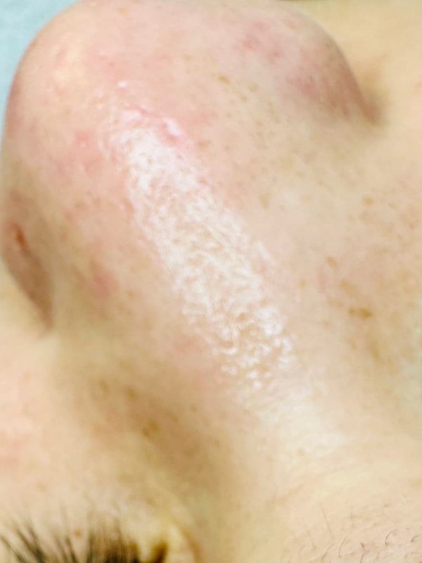 After Microneedling at NP Skin Care