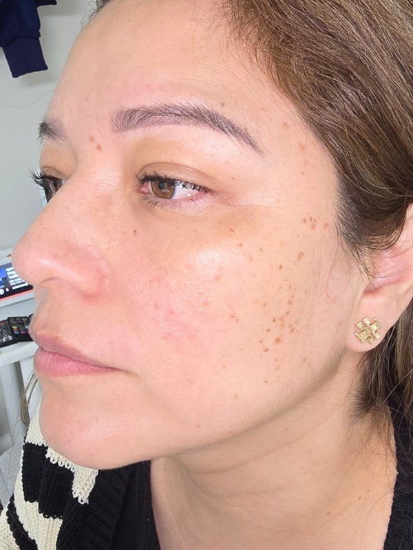 Before Melasma / Dark Spots treatment at NP Skin Care