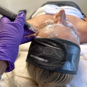 Microneedling with exosomes treatment at NP Skin Care in Greenwich, CT